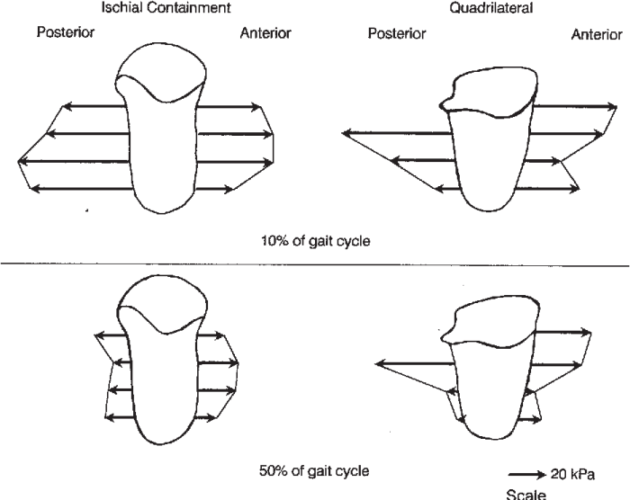 Socket ischial containment biomechanics