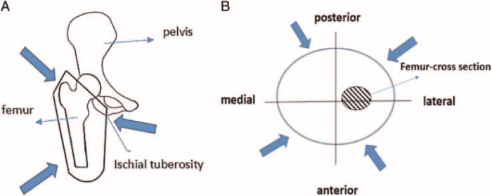 Quadrilateral socket vs ischial containment