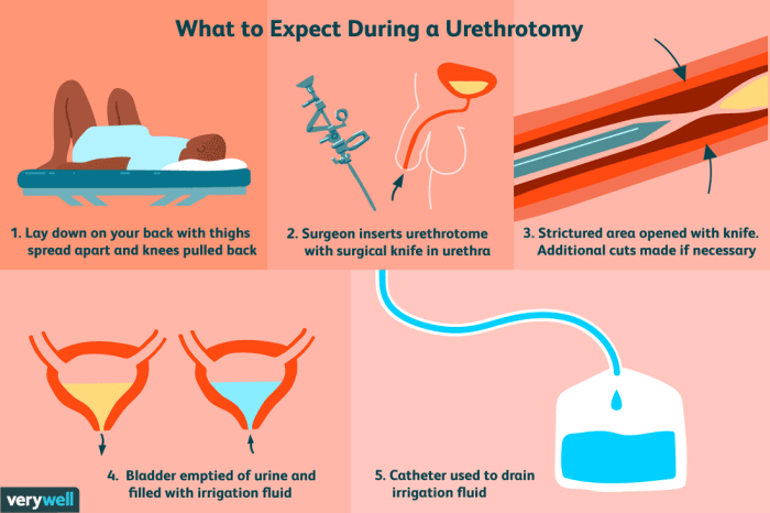 Urethrorrhea is bleeding from the urethra